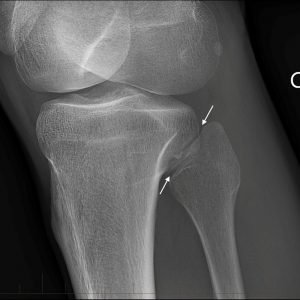 Chấn thương sụn khớp