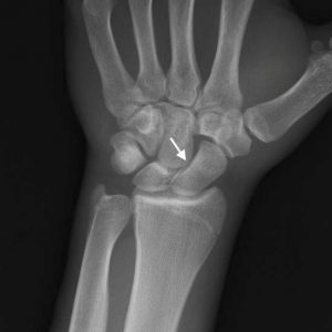 Vỡ xương thuyền