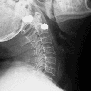 Dị vật thực quản