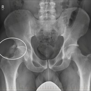 Chấn thương cơ thẳng đùi