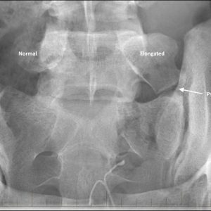 Hội chứng Bertolotti