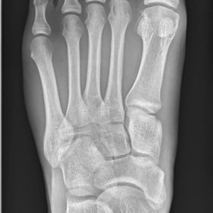 Chấn thương bàn chân