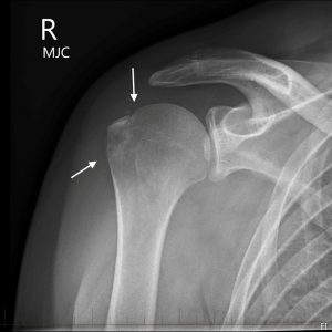 Vỡ mấu động lớn