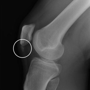 Viêm gân bánh chè