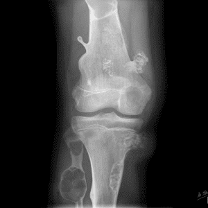 U xương < 30 tuổi