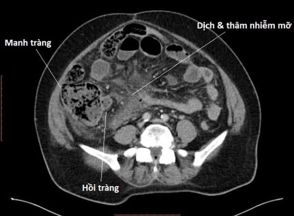 Apxe ruột thừa