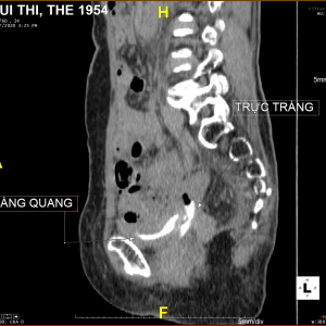 Rò trực tràng - bàng quang