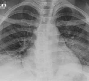 Hội chứng ngực cấp