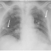 Viêm phổi Covid 19 - Hình ảnh 2