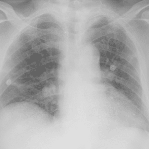 Viêm phổi Covid 19