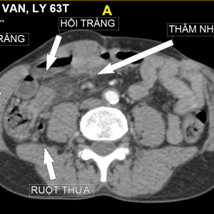 Túi thừa ống tiêu hóa