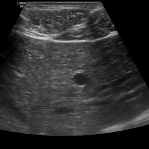 Hamartoma đường mật