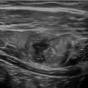 Chấn thương thành bụng