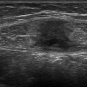 Chấn thương thành bụng