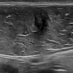 Chấn thương thành bụng