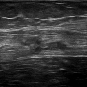 Chấn thương thành bụng