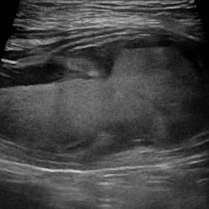 Chấn thương thành bụng