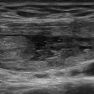 Chấn thương thành bụng