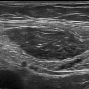 Chấn thương thành bụng