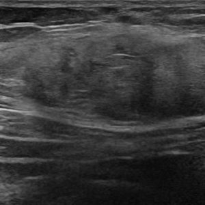 Viêm mô mỡ thành bụng