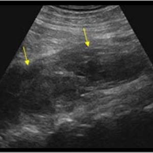 Tụ máu cơ thắt lưng chậu