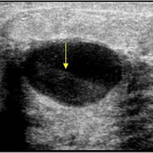 Nang tuyến vú