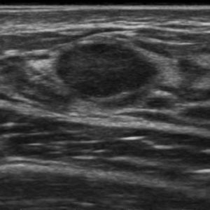 U xơ tuyến vú