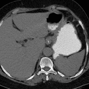 Túi thừa dạ dày