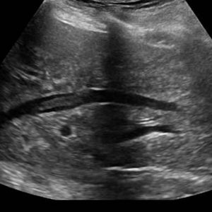 Huyết khối TM gan