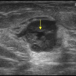 Ung thư vú