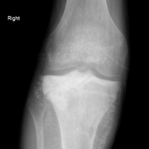 Sarcoma xương