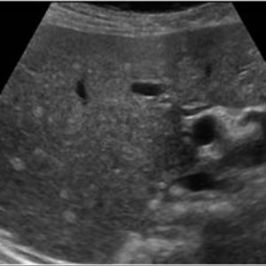 Hamartoma đường mật