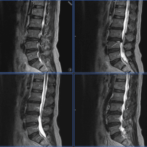 Thoát vị đĩa đệm