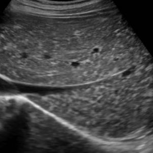 Hamartoma đường mật