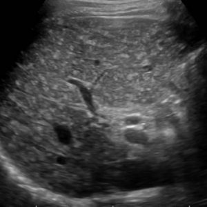 Hamartoma đường mật