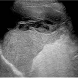 Chấn thương lách