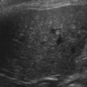 Hamartoma đường mật