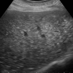 Hamartoma đường mật