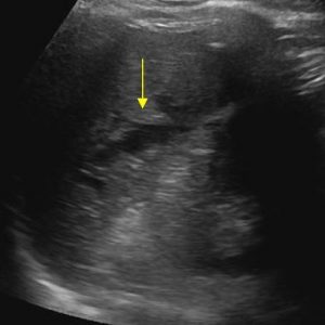 Chấn thương lách