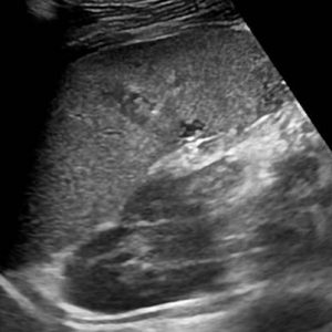 Chấn thương lách