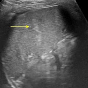 Chấn thương lách