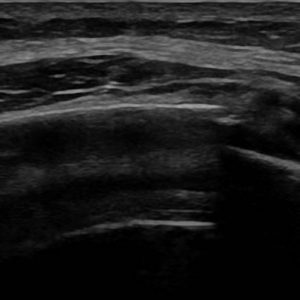 Gãy xương sườn