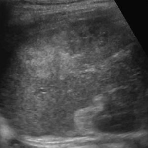 Chấn thương lách