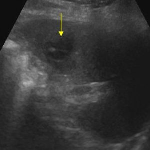 Chấn thương lách