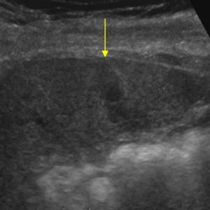 Chấn thương lách