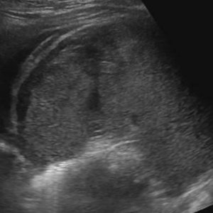 Chấn thương lách