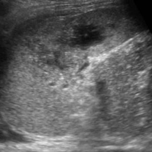 Chấn thương lách