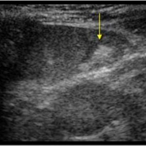 chấn thương lách