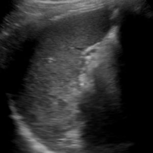 Chấn thương lách