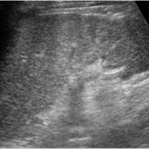 Chấn thương lách